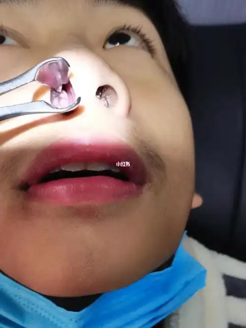 严重鼻甲肥大过敏性鼻炎