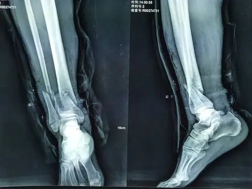 左胫腓骨远端开放性粉碎性骨折