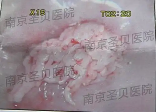 发生在女性宫颈部位的尖锐湿疣,一般是由于男性伴侣先感染该病,由于没