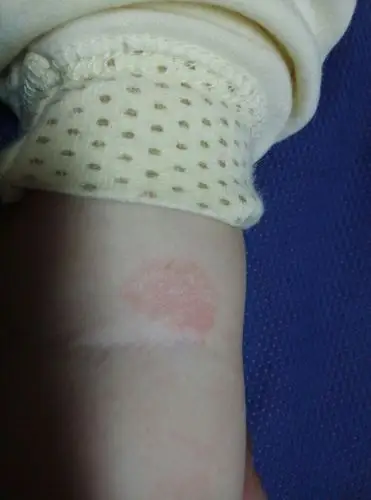 宝宝快七个月了今天胳膊上张了一小片红红的好像是皮癣好怕怕啊