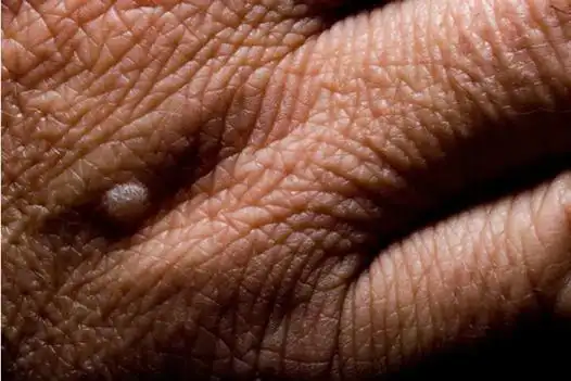 一文全解:男性感染hpv的问题