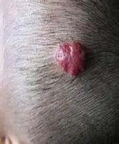 头皮肿瘤 - 好大夫在线