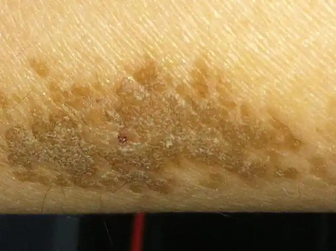 疣状痣如何停止扩散及治愈方法