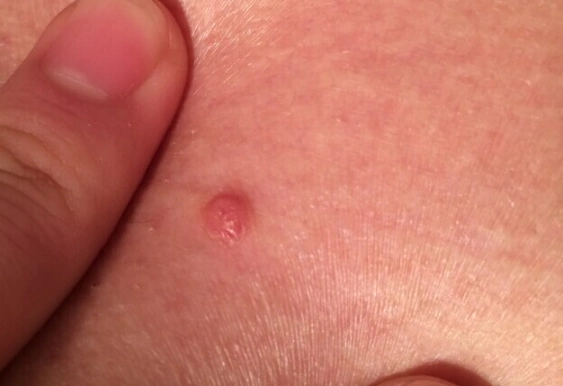 梅毒前期小红点图片 (13)_有来医生