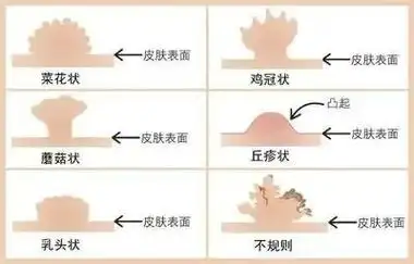 同房前,怎样快速判断对方有没有性病?
