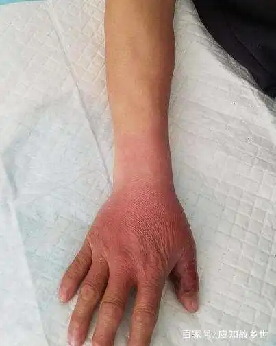 不敢相信!一男子被毒蛇咬伤,自行处理伤口并喝酒,出现异常!