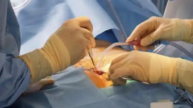 在中国,结扎这件事,从没有平等过|输卵管|手术|避孕|节育器|输精管