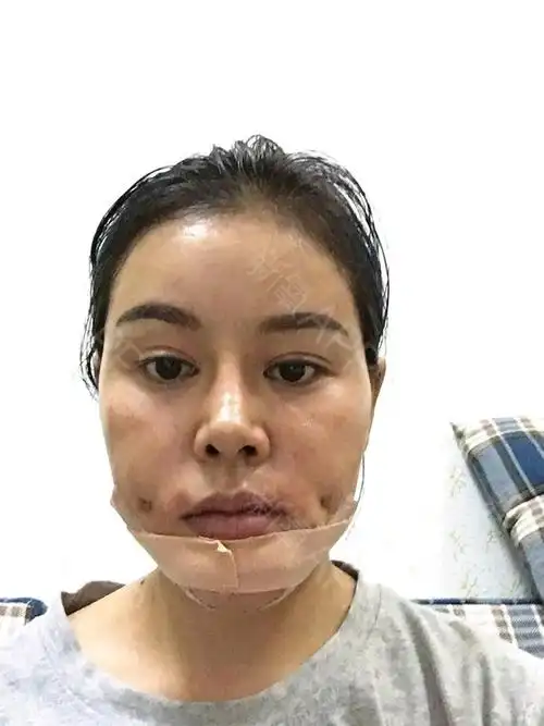 【整容案例】酒窝成形术(人造酒窝)|原来有了酒窝可以笑得这么没