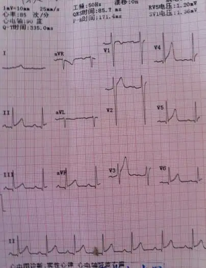心电图窦性心律心电轴轻度右偏