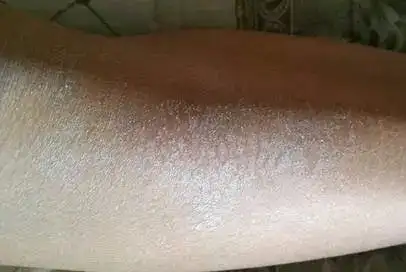 每次脱衣服腿上都有很多皮屑脱落医生提醒这种维生素该补了