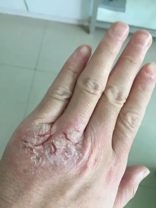 手上关节处 反反复复的好了又裂开好了又裂开不会好 好了又有水泡挤了