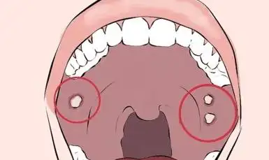 口腔黏膜出现白斑,可以自愈吗?