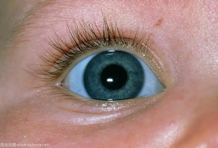 成骨不全症成骨不全症第三型