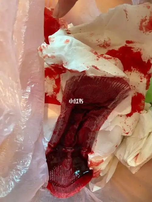 产后十天大出血有图慎入