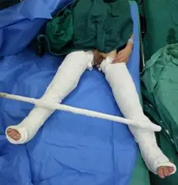 脑瘫手术视频脑瘫手术后石膏固定绑腿倒吊小儿脑瘫双放腿手矫畸形术室