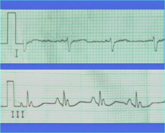 p>心电轴右偏是见于正常 a href="#" data-lemmaid="9340888">垂位心