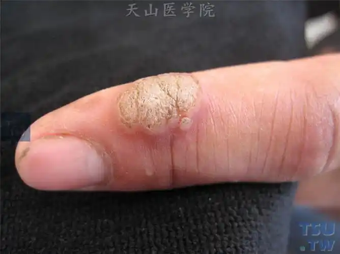 寻常疣verrucavulgaris症状表现