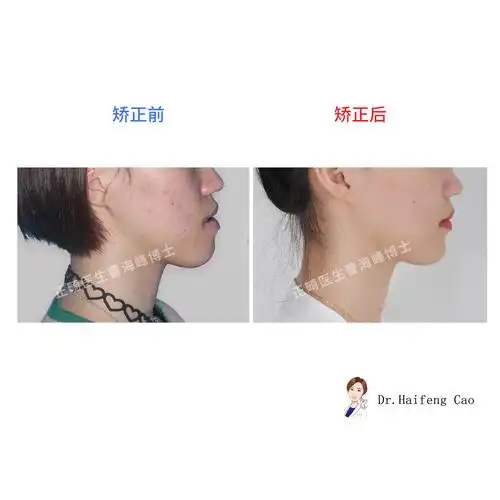 骨性地包天矫正案例