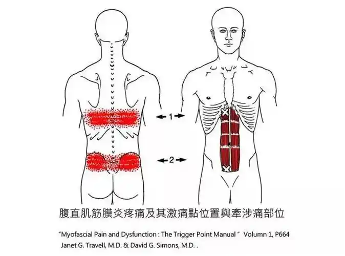 腹直肌筋膜疼痛如何处理