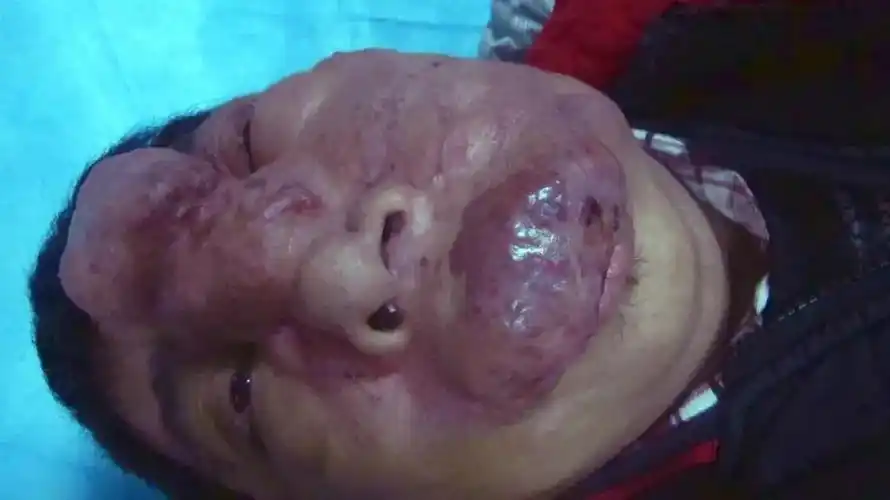 面部血管瘤患者有哪些饮食注意事项这些细节都很重要