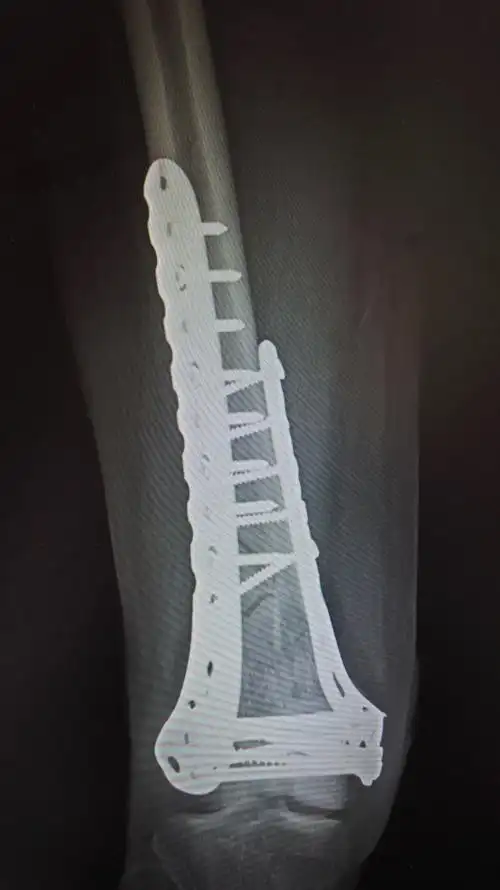 下肢股骨远端骨折1例,伴髌骨骨折 - 好大夫在线