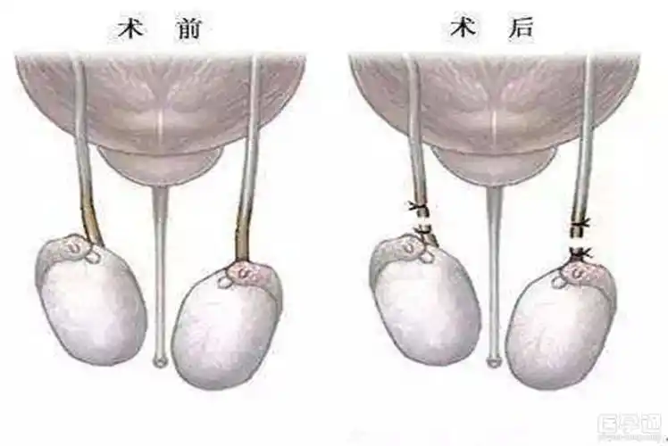 男性结扎对身体和性功能有影响吗硬度时间感觉一模一样