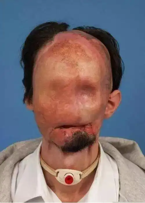 无脸人:真实存在的无脸人