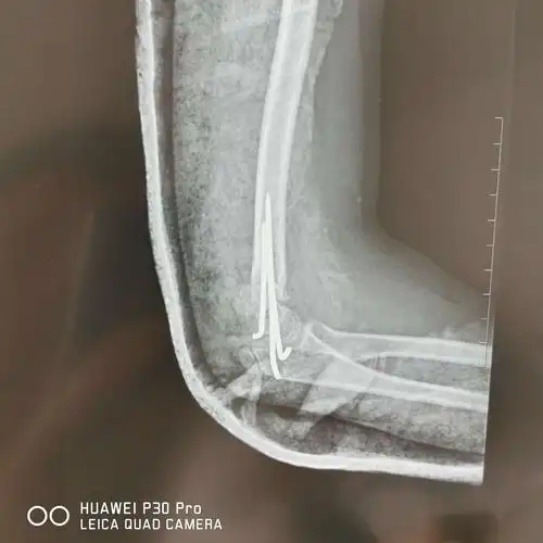 儿童肱骨髁上骨折(屈曲型)