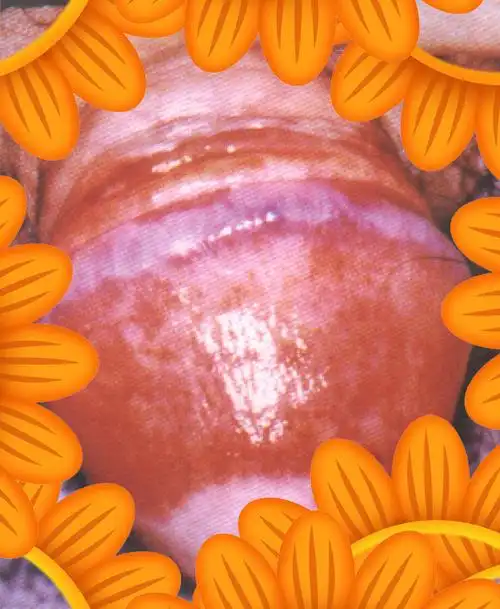 得了「浆细胞性包皮龟头炎」别着急,看这文章就清楚了