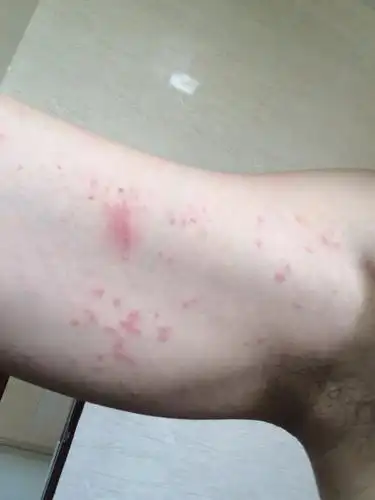 身上长了很多一粒粒的红疹子,有的一颗颗分散的,有的是一片的,痒了