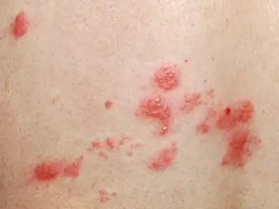 性病性淋巴肉芽肿图片_性病性淋巴肉芽肿症状表现图片大全_有来医生