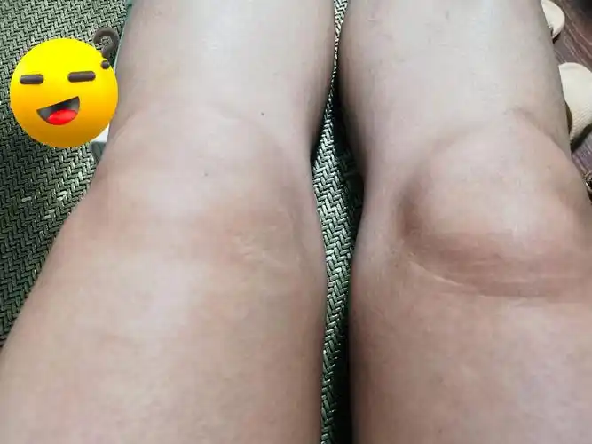 哎哟哟,,^,, 我的波棱盖～～肿～么了