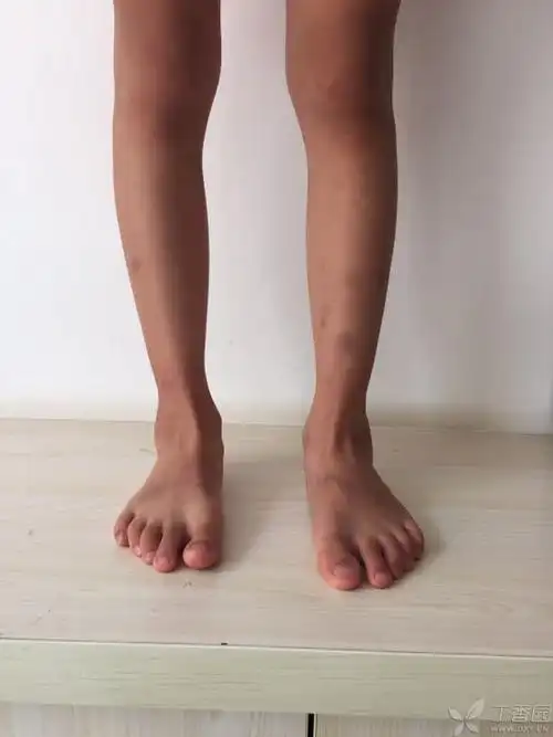 儿童踝关节外翻 [病例帖]