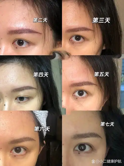纹眉一周后续|第7⃣️天结痂啦好痒!