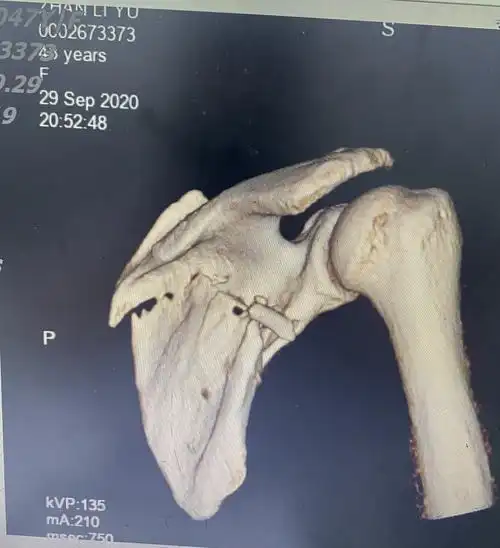 肩胛骨粉碎性骨折治疗1例