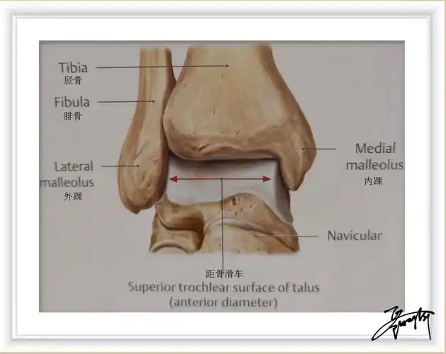 踝关节由距骨,胫骨远端,内踝,外踝构成,距骨分为距骨头,颈,体(滑车)