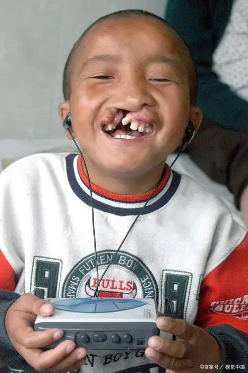 新生为什么会发生腭裂?怎么治疗?新手爸妈应注意什么?