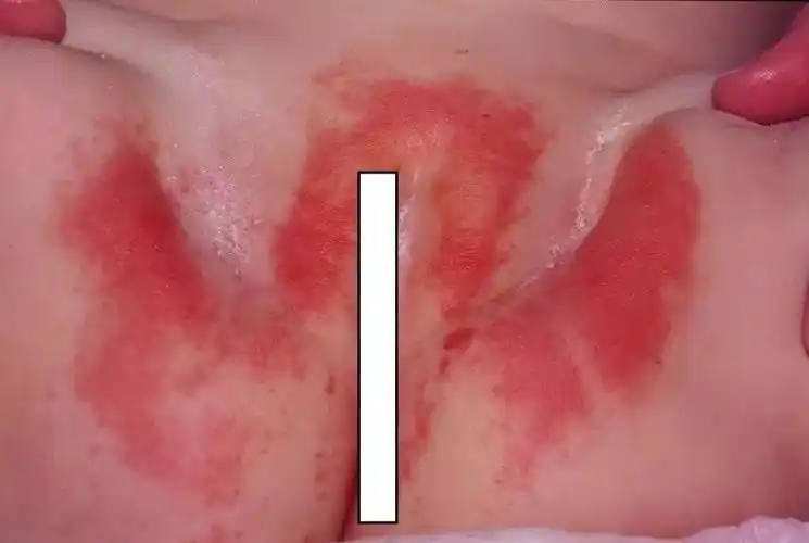 keroo纸尿裤分享宝宝红屁屁知多少