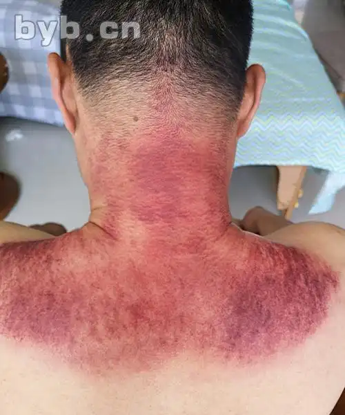 肩颈的出痧也比较猛,且集中在小肠经上,这和经常用电脑,思虑过多