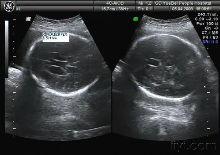 比较少见的胎儿侧脑室前角积液