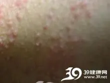 外阴鳞状上皮疣状增生