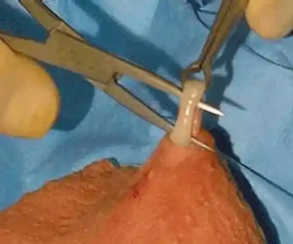 关爱家庭性福,呵护男性健康—滨医附院生殖医学科男性输精管结扎术