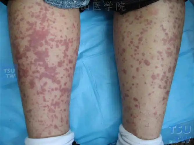 过敏性紫癜(anaphylactoid purpura)症状表现