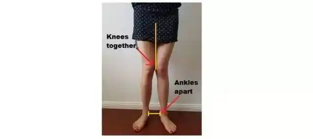 超级科普膝盖内扣knockknees连载一二