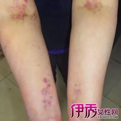 【图】女性淋病梅毒图片大全 淋病早期症状有哪些?