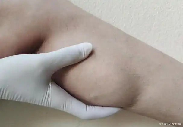 或是神经元出现问题,可能会导致患者腿部关节的疼痛和小腿肌肉萎缩