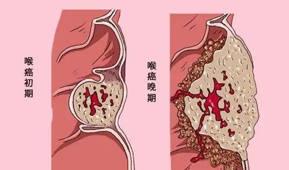 别把喉癌当成咽炎,若颈部有5种表现,建议引起重视,别后知后觉