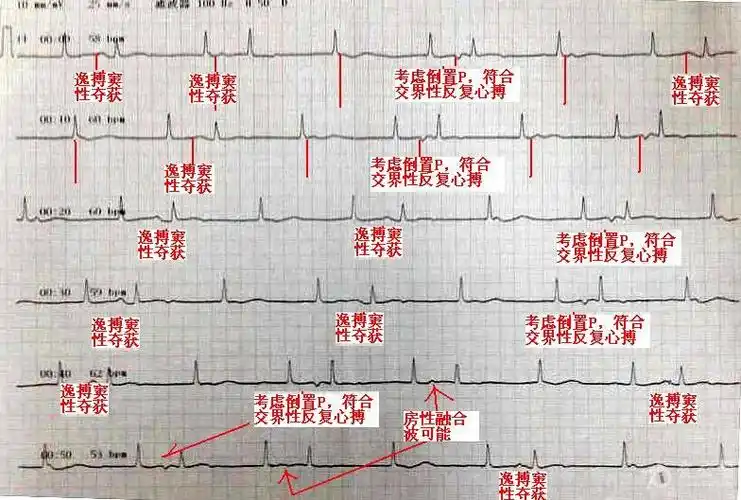 [心电图分析] 倒置的p波?