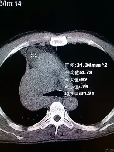 【读片】右肺上叶中央型肺癌,前纵隔囊性密度影是什么结构 [病例帖]