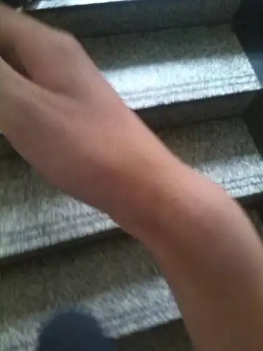 打排球导致,手腕肿起一大块,休息一周,消肿,皮肤变青,今天又